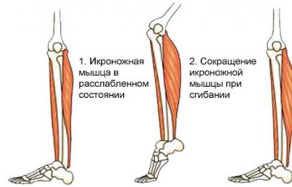 اگر عضله ساق پا مچاله شد چه باید کرد؟