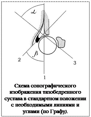 Тазобедренные суставы узи норма. УЗИ тазобедренных суставов у новорожденных норма. Углы при дисплазии тазобедренных суставов у грудничков норма. Угол Альфа тазобедренного сустава норма. УЗИ тазобедренного сустава у новорожденных норма углов таблица.